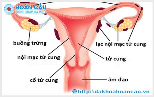 Lạc nội mạc tử cung là gì ? Có nguy hiểm không ?