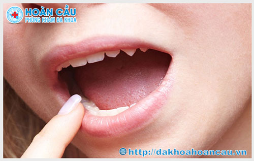 Biểu hiện bệnh lậu ở miệng và cách điều trị hiệu quả	