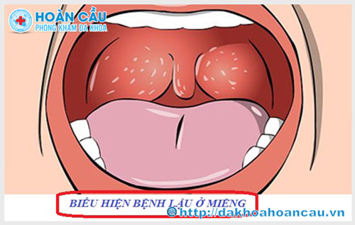 Biểu hiện bệnh lậu ở miệng và cách điều trị hiệu quả	