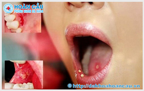 Mụn mọc ở lưỡi và môi là bị bệnh gì
