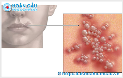 Bệnh mụn rộp sinh dục có nguy hiểm không?	