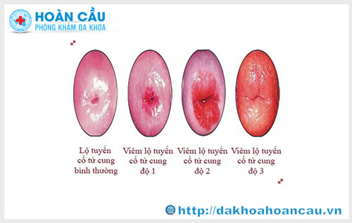 Nguyên nhân gây bệnh viêm lộ tuyến cổ tử cung