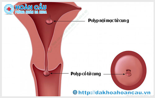 Nguyên nhân gây ra bệnh Polyp cổ tử cung