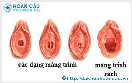 Những dấu hiệu nhận biết rách màng trinh