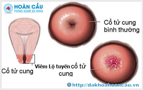 Những hình ảnh bệnh viêm lộ tuyến cổ tử cung