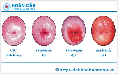 Những hình ảnh bệnh viêm lộ tuyến cổ tử cung