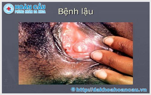 Những hình ảnh rõ nét về căn bệnh lậu