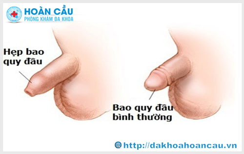 Những nguy hại của triệu chứng hẹp bao quy đầu