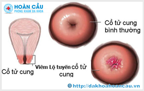 Viêm lộ tuyến cổ tử cung có nguy hiểm không ?