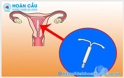 Vòng tránh thai được đặt như thế nào?