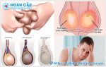 Sưng tinh hoàn là dấu hiệu của bệnh gì?