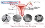 Tìm hiểu về bệnh viêm ống dẫn trứng