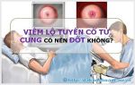 Viêm Lộ Tuyến Cổ Tử Cung Liệu Có Nên Đốt Hay Không?