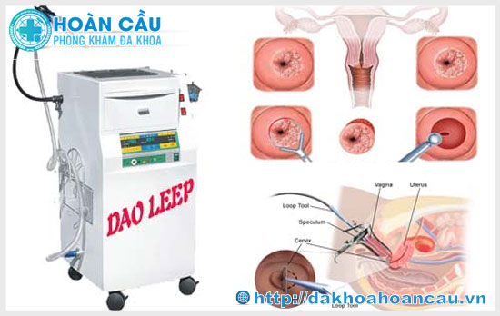 Điều trị viêm lộ tuyến cổ tử cung thành công bằng Dao Leep tại Hoàn Cầu