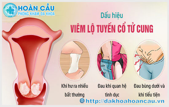 Hình ảnh dấu hiệu nhận biết bệnh viêm lộ tuyến cổ tử cung 