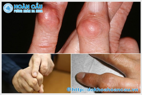 Khớp tay bị sưng đau là triệu chứng liên quan tới nhiều bệnh xương khớp nguy hiểm
