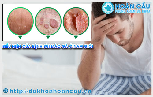 Nhận biết chính xác các triệu chứng bệnh sùi mào gà ở nam giới