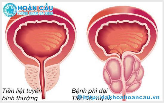 Phình to tuyến tiền liệt là như thế nào?