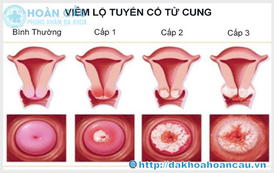 Hình ảnh bệnh viêm lộ tuyến cổ tử cung qua các giai đoạn phát triển